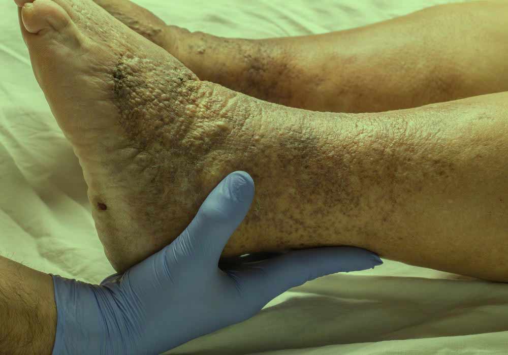venous-thrombosis